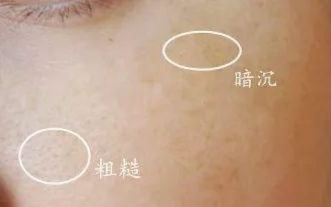瘦脸针和光子嫩肤