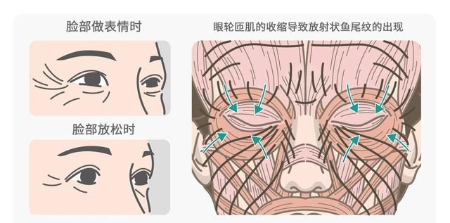 减轻眼部鱼尾纹，眼睛周围鱼尾纹怎么办图8