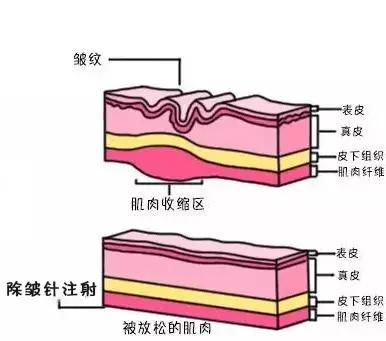 脸上有皱纹打除皱针好吗图2