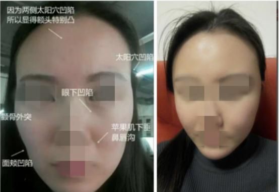 除皱好还是填充好图6