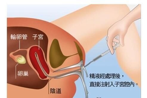 人工受精成功率，人工受精的成功几率有多大图3