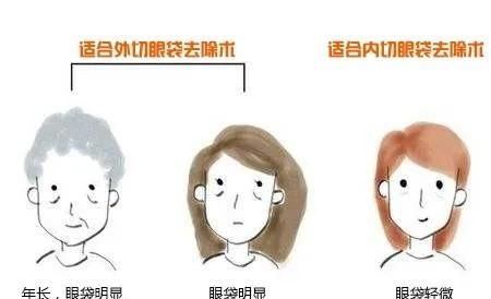 不开刀除皱，怎样不开刀去眼袋和细纹图2