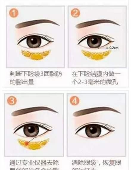 不开刀除皱，怎样不开刀去眼袋和细纹图3