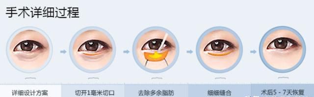 不开刀除皱，怎样不开刀去眼袋和细纹图4
