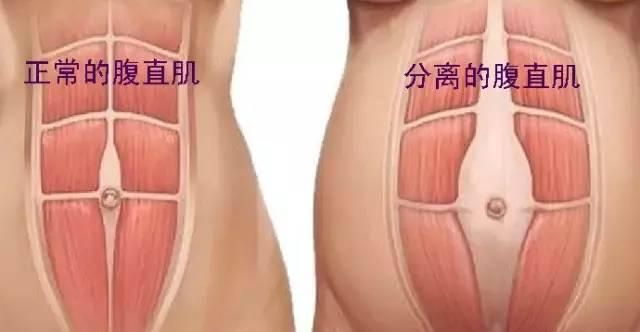 产后瘦肚子哪种好纱布，收腹带，束身衣，都4个月了还是肉肉图1