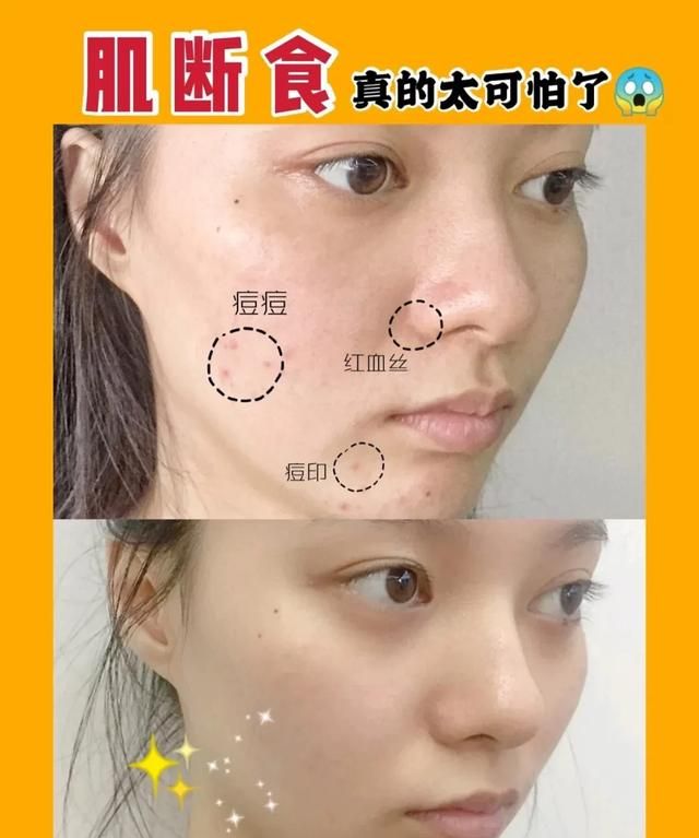 痘坑最有效的方法图1
