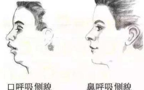 长期用嘴巴呼吸