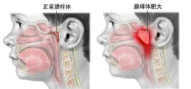 长期用嘴巴呼吸图3