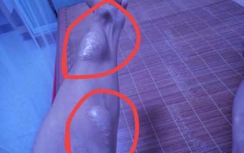 透析是什么，做透析是什么感觉