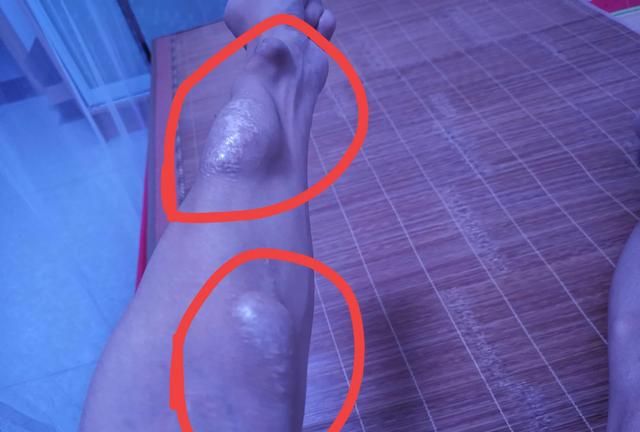 透析是什么，做透析是什么感觉图1