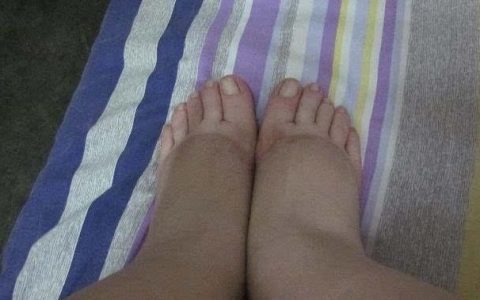 男性水肿是什么原因造成的