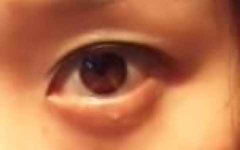 为什么脸上会长小米粒一样的痘痘