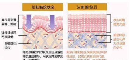 注射式除皱，注射胶原蛋白除皱能维持多少时间图4