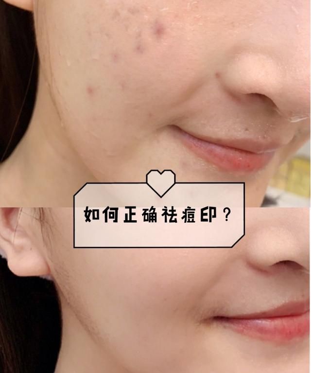 痤疮痘印，怎么才能去掉脸上的痘痘和痘印图1