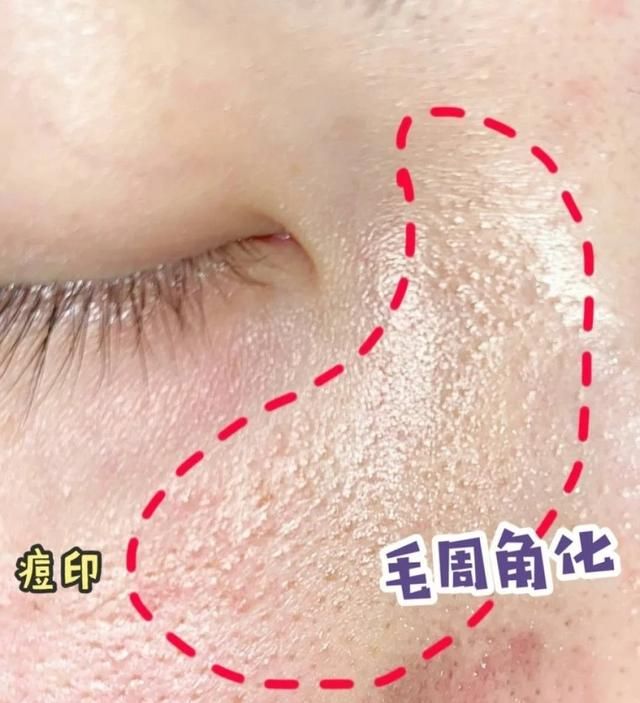 怎么去毛孔，怎样才能去黑头让毛孔变细图1