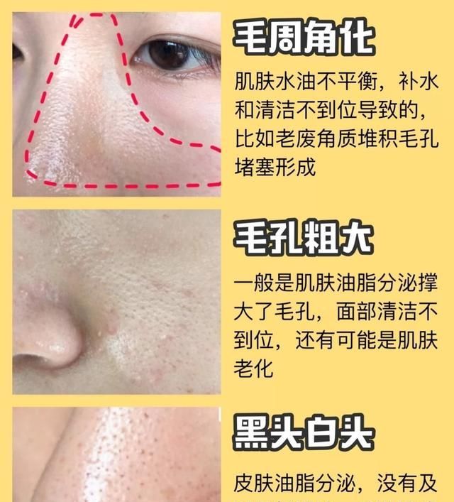 怎么去毛孔，怎样才能去黑头让毛孔变细图2