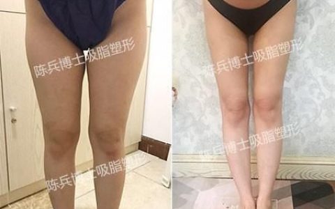 什么样的人适合抽脂减肥
