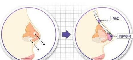 假体隆鼻恢复时间，做假体隆鼻要多久恢复图1
