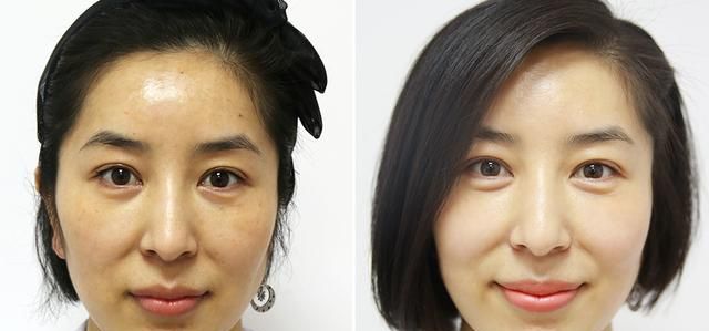 白醋泡白术能祛斑吗图2