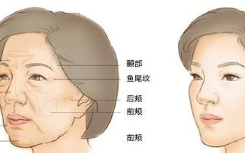 鼻唇沟整形，填充鼻唇沟的三大方法