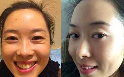 怎样才能去皱纹，白醋加什么能去皱纹