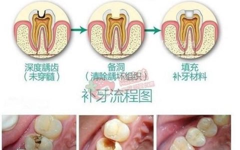 补牙过程图解，补牙的过程和步骤有哪些