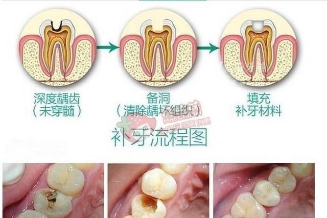 补牙过程图解，补牙的过程和步骤有哪些图1