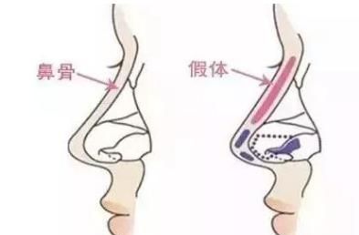 假体隆鼻手术的注意事项(假体隆鼻后效果自然吗)图2