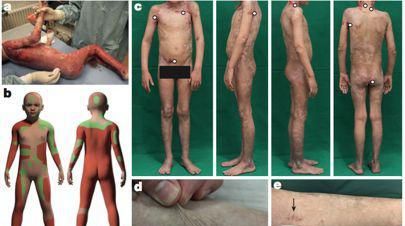 植皮手术后皮肤图：哈桑的皮肤移植图2