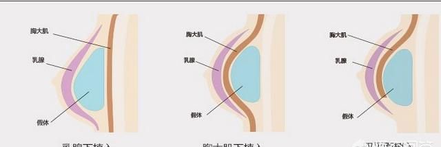 健康丰胸法，简单有效的丰胸方法有哪些图2