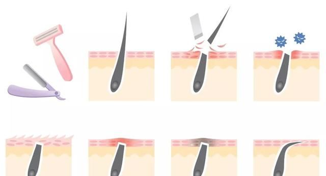 脸部怎么脱毛，脸上长毛用什么脱毛图2