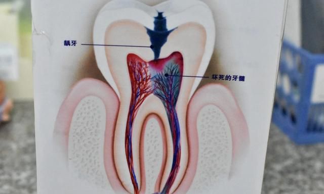 蛀牙疼怎么办，有蛀牙疼痛怎么办图2