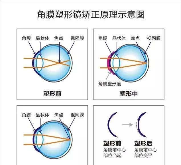 角膜塑形镜的危害，角膜塑形镜有什么副作用图2
