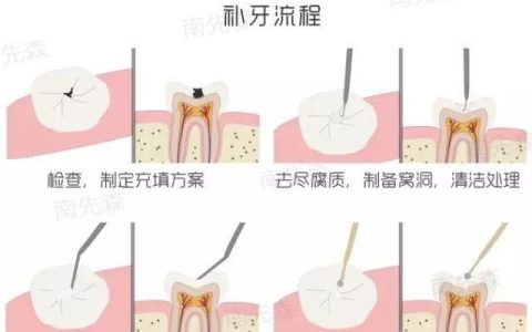 蛀牙疼怎么办，蛀牙疼痛难忍怎么办