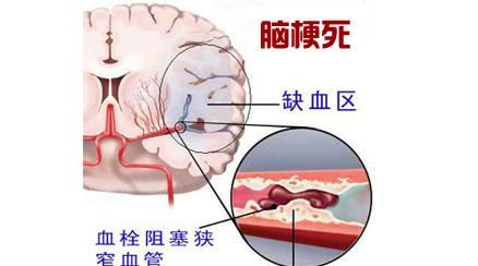 脑梗塞是什么引起的原因图1