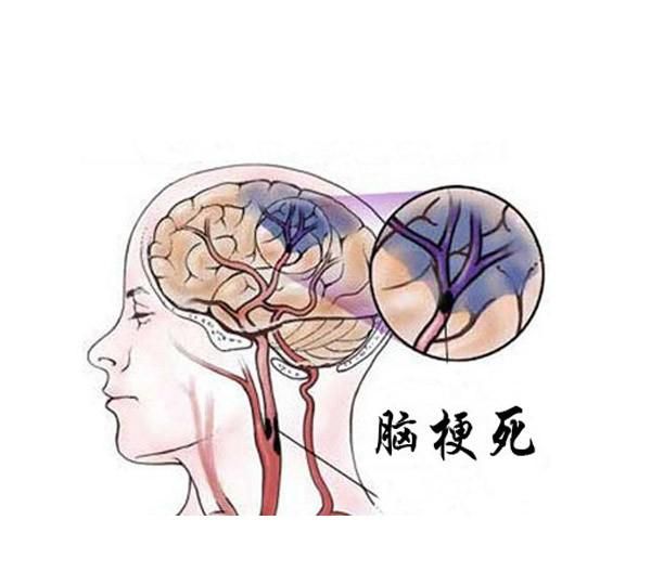 脑梗塞是什么引起的原因图2