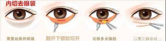 眼袋消除价格，眼袋怎么消除手术价格图1