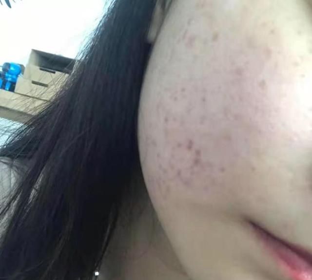 如何治痘痘最有效的方法图2