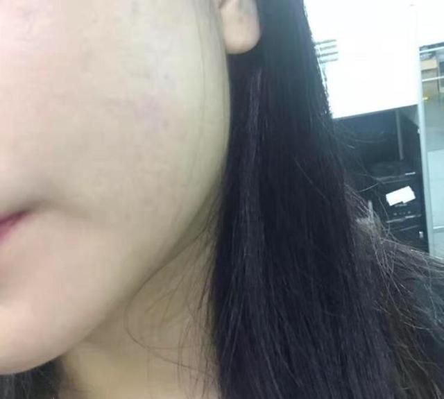 如何治痘痘最有效的方法图3