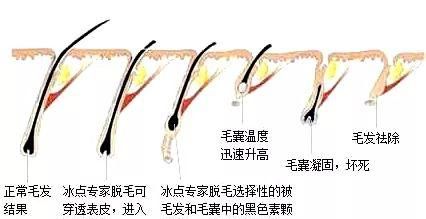 冰点脱毛的副作用，冰点脱毛有啥副作用吗图4