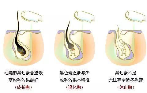 冰点脱毛的副作用，冰点脱毛有啥副作用吗图6