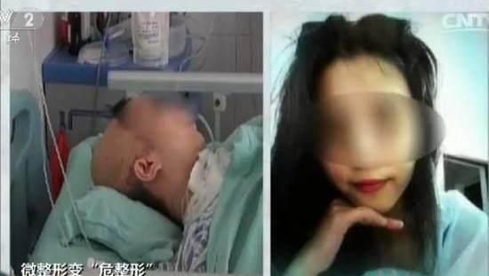 你怎么看“危整形”女子填充太阳穴致偏瘫生命几度垂危图4