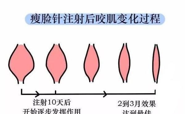 注射瘦脸美容，注射瘦脸针有危险吗图5