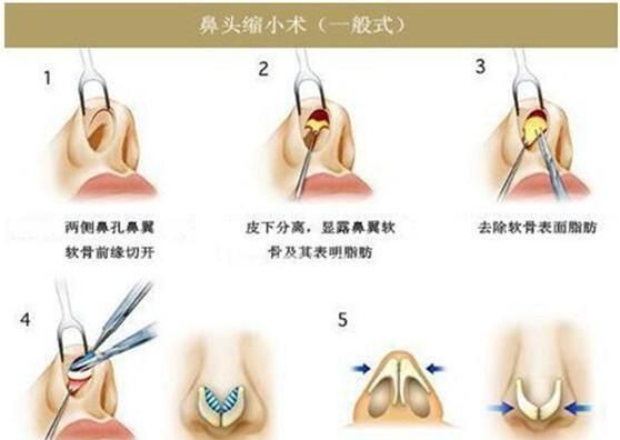 做鼻综合手术之前需要注意什么图2