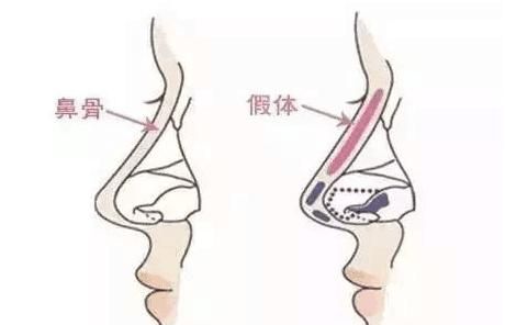 做鼻综合手术之前需要注意什么图3