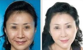 面部提升方法，60岁面部提升做什么好图2