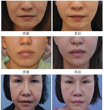 面部提升方法，60岁面部提升做什么好图7