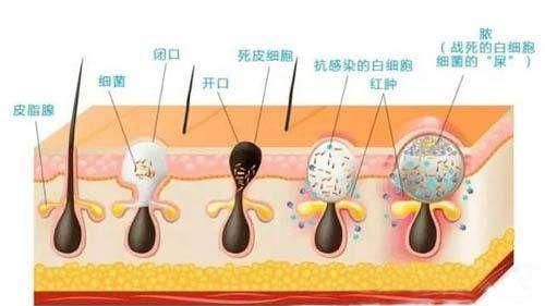 青春痘的症状，青春痘的主要症状图1