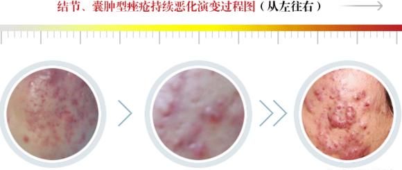 青春痘的症状，青春痘的主要症状图8