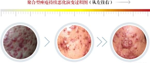 青春痘的症状，青春痘的主要症状图9